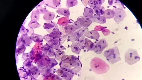 Atypical squamous cells, human papillomavirus or yeast infection. Video stock 337722643