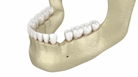 Augmentation Surgery - Adding new bone and implant. 3D animation Video stock 129308346