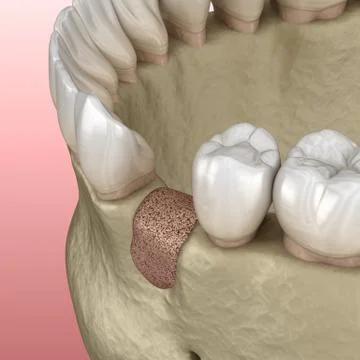 Augmentation Surgery - Adding new bone. 3D illustration イラスト素材
