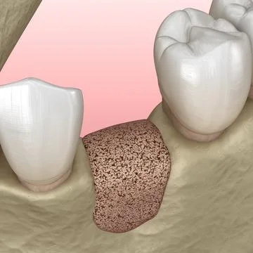 Augmentation Surgery - Adding new bone. 3D illustration Illustrazione stock