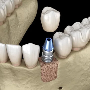 Augmentation Surgery - Adding new bone. 3D illustration Stock Illustration