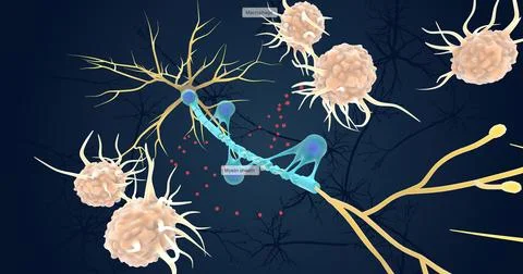 Autoimmune Attack on Myelin Sheath Stock Illustration