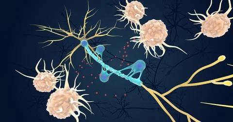 Autoimmune Attack on Myelin Sheath Stock Illustration