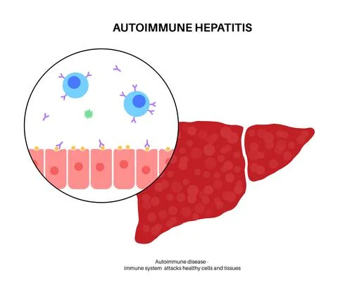 Autoimmune hepatitis disease Stock Illustration