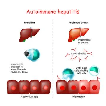 Autoimmune hepatitis Stock Illustration