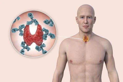 Autoimmune thyroiditis, conceptual illustration Stock Illustration