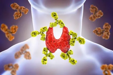 Autoimmune thyroiditis, Hashimoto's disease Stock Illustration