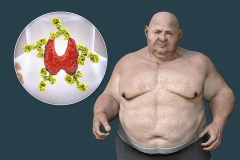 Autoimmune thyroiditis in obesity, conceptual 3D illustration showing an ov.. Stock Illustration