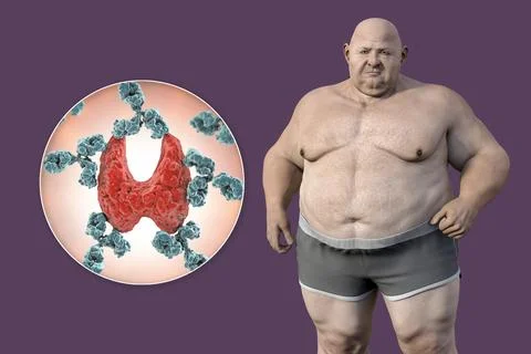 Autoimmune thyroiditis in obesity, conceptual 3D illustration showing an ov.. Stock Illustration