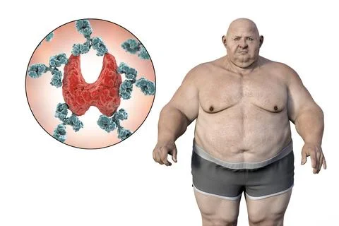 Autoimmune thyroiditis in obesity, conceptual 3D illustration showing an ov.. 库存插图