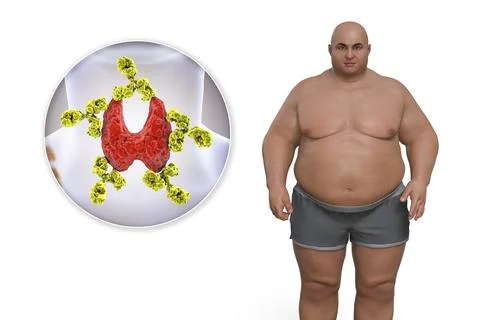 Autoimmune thyroiditis in obesity, conceptual 3D illustration showing an ov.. Stock Illustration