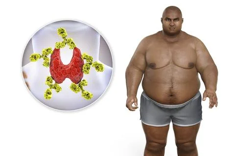 Autoimmune thyroiditis in obesity, conceptual 3D illustration showing an ov.. 库存插图
