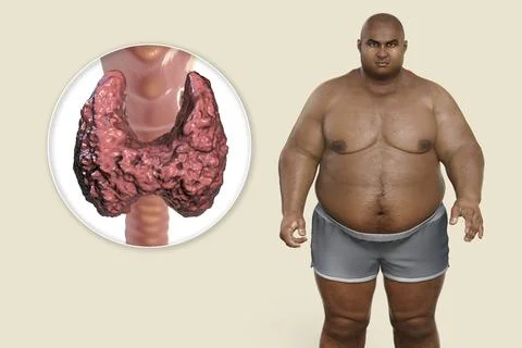 Autoimmune thyroiditis in obesity, conceptual 3D illustration showing an ov.. Stock Illustration