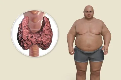 Autoimmune thyroiditis in obesity, conceptual 3D illustration showing an ov.. Stock Illustration