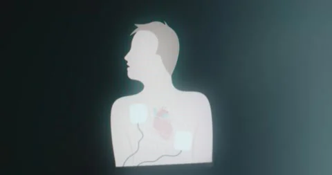 Automated External Defibrillator connected to a human torso Video stock 314501199