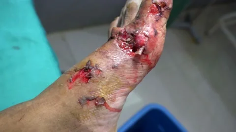 Avulsion Left Foot Stock Footage 144425580