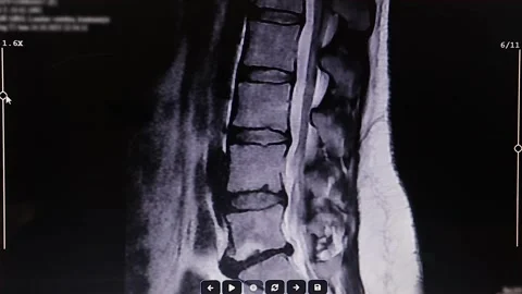 Axial CT Scan of Bipolar Disc Herniation With Anterior and Posterior Extension Stock Footage 326646330