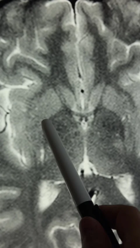 Axial T2 Brain MRI Scroll with Pointer Highlighting Neuroanatomy Stock Footage 314854294