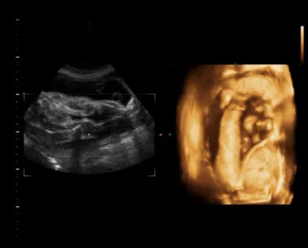 Baby 3D ultrasound exam Stock Footage
