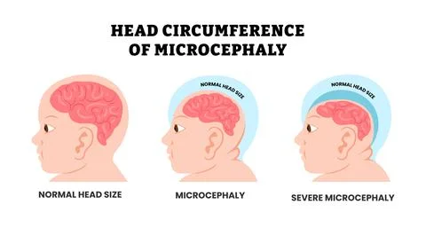 Baby head circumference of microcephaly, educational medical poster design .. Stock Illustration