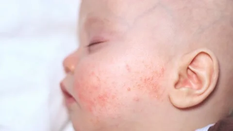 Baby infant's problem red rush on a cheek Stock-Footage 154730290