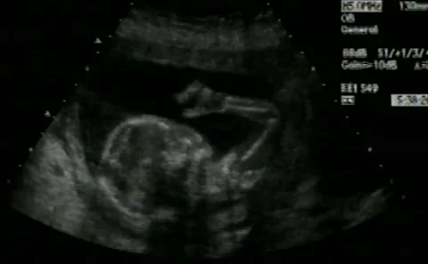Baby Sonogram Vídeos de archivo 297265006