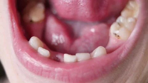 Baby teeth fall out, break, turn black, become infected. Caries in children. Stock Footage 169802452