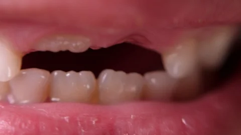 Baby teeth macro shoot. Toothless smile. A wobbly tooth. Cutting root tooth Stock Footage 118825754