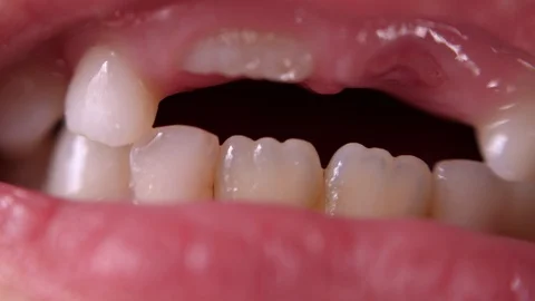 Baby teeth macro shoot. Toothless smile. A wobbly tooth. Cutting root tooth Video stock 118825853
