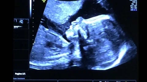 Baby yawning during Ultrasound scan (6 months-21st weeks) with heartbeat sound Stock Footage