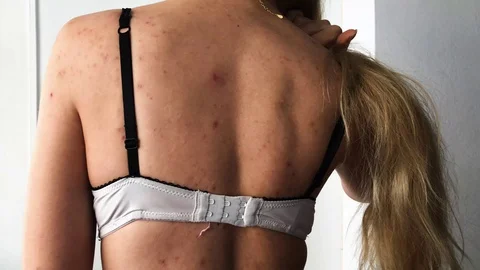 Back Acne Stockbeeldmateriaal 98781046