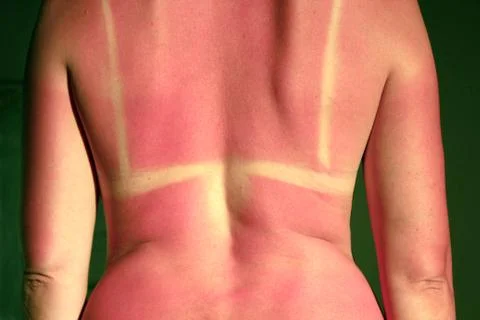 Back burnt after sunburn Stock Photos