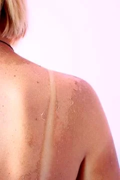 Back burnt after sunburn Stock Photos