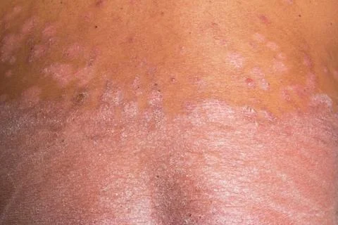The back is full of psoriasis Foto stock