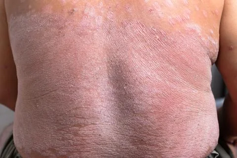 The back is full of psoriasis Stock Photos