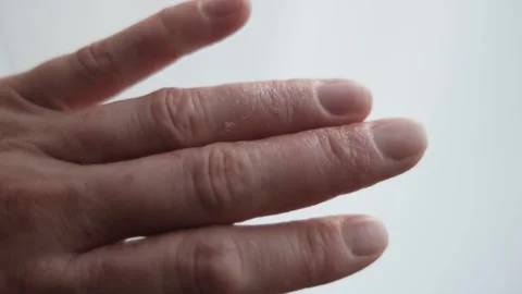 Back-hand close shot displaying eczema lesions and flakes Stock Footage 310913927