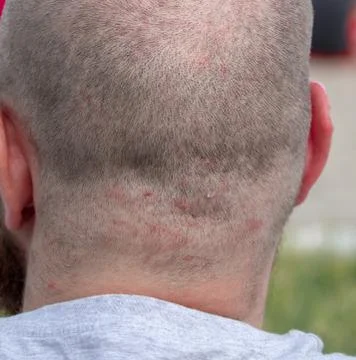 Back of the head of a short haired man suffering from scalp acne problem Stock Photos
