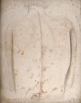 The back of a man suffering with lesions or sores. Watercolour by C. D'Alto.. Stock Illustration