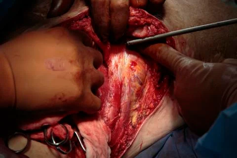 Back muscles during surgery Photos