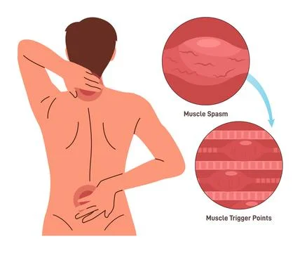 Back pain. Character having neck and shoulder muscle spasm. Trigger Stock Illustration