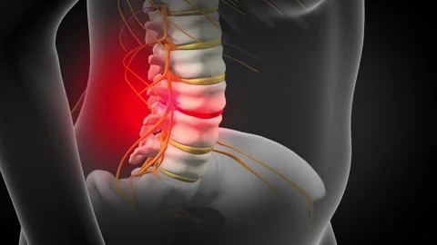 Back Pain, could be caused by spinal disc herniation/ slipped disc Stock Footage 262961877