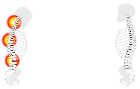 Back Problems Healthy Back Pain Slipped Disc Prolapse Stock-Illustration