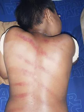 Back scraping method Stock Photos