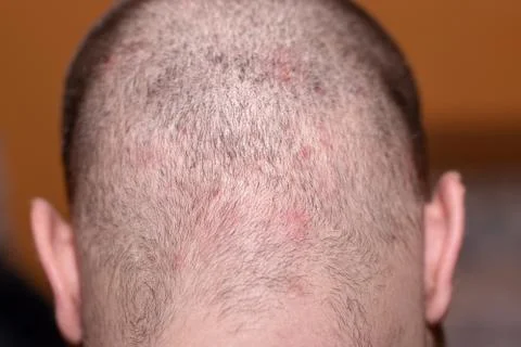 Back side of a man's head suffering from scalp acne Stock Photos