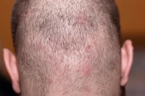 Back side of a man's head suffering from scalp acne Stock Photos