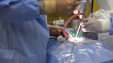 Back Surgery or Minimally Invasive Spine Surgery 6 動画素材 107048646