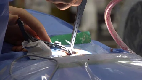 Back Surgery or Minimally Invasive Spine Surgery 3 Stock Footage 107048649
