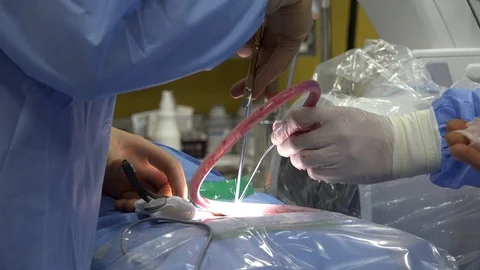 Back Surgery or Minimally Invasive Spine Surgery 2 Stock Footage 107048650