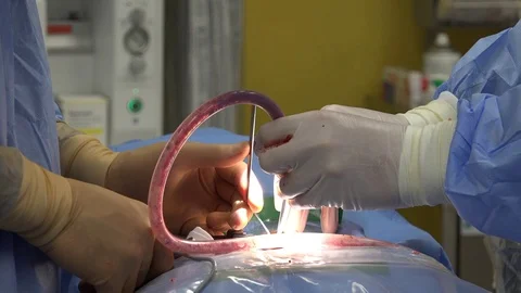 Back Surgery or Minimally Invasive Spine Surgery 7 Stock Footage 107048670
