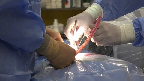 Back Surgery or Minimally Invasive Spine Surgery 動画素材 107048673